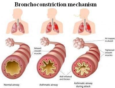 Bronchoconstriction Causes and Natural CO 2 -Based Treatment