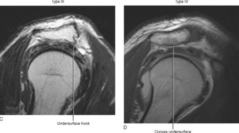 IMAGING OF THE SHOULDER | Radiology Key