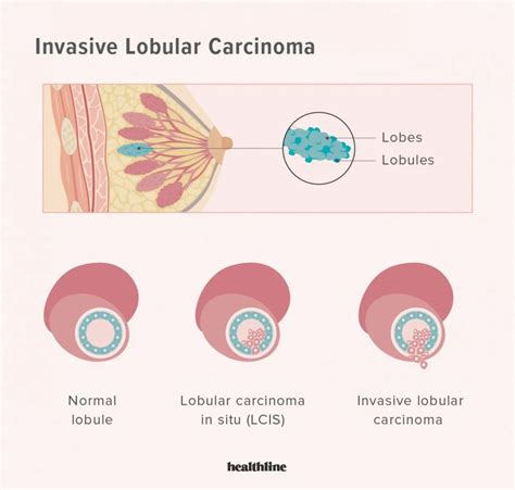 Invasive Breast Cancer: Types, Symptoms, Treatment, and Outlook