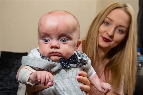 Baby born without skin on almost his entire body defies doctors odds to survive