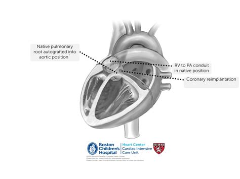 Ross Procedure – Online supplement