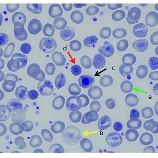 | Peripheral Blood Smear, Brilliant Cresyl Blue Stain. (a) Heinz bodies ...