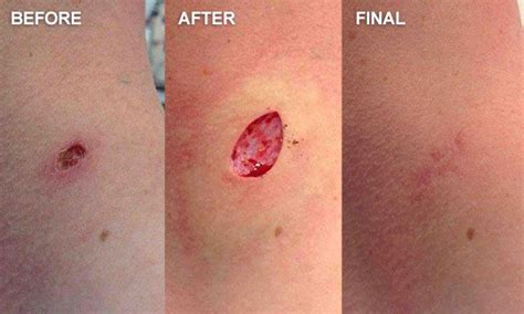 Shave Biopsy Healing Pictures - Rough Skin On Hands Mdedge Family Medicine : The doctor shaves a ...