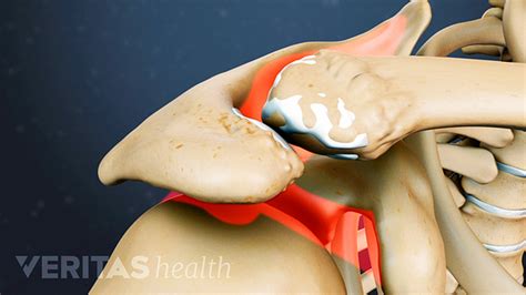 What is Acromioclavicular Arthritis (AC Joint Arthritis)? | Arthritis-Health