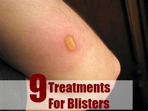 9 Effective Treatments For Blisters | Blister treatment, Treatment, Health tips