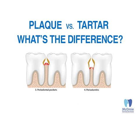 Plaque vs. Tartar: What’s The Difference? - McOmie Family Dentistry
