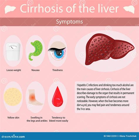 Symptoms of Cirrhosis Oh the Liver. Stock Vector - Illustration of illness, cartoon: 94612259