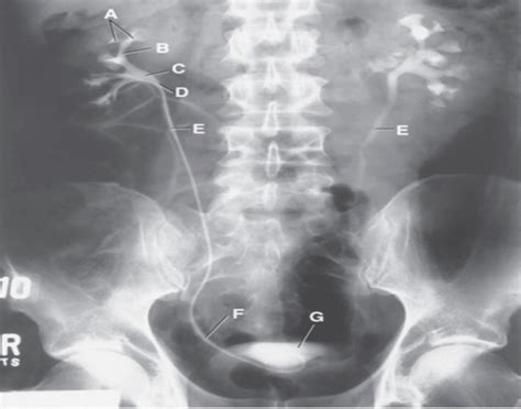 Retrograde Pyelogram Quiz