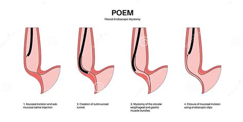 POEM medical poster stock vector. Illustration of esophageal - 291547409