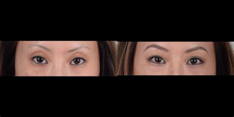 Lateral canthoplasty Before and After Photo Gallery | Dr. Kenneth Kim