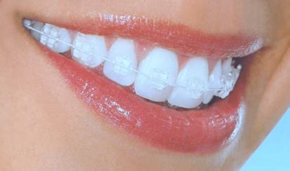 What are the Types of Invisible Braces Available? - Charlton Health - Get Answers to Your Health ...