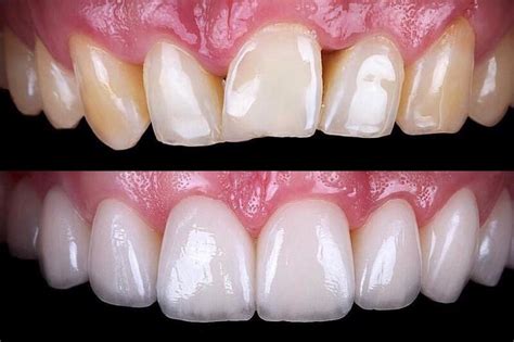 Dental Veneers: Pros And ConsDr. Jacquie