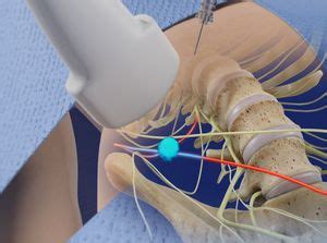 Ultrasound-Guided Ilioinguinal Nerve Block - Nevada Pain Care