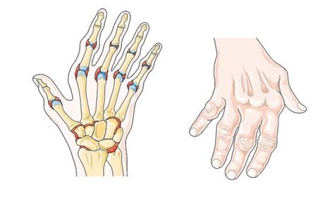 What is the Difference Between Palindromic Rheumatism and Rheumatoid Arthritis | Compare the ...