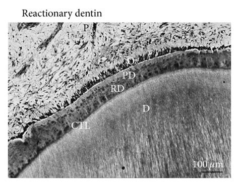 Reparative and reactionary dentin formation. After filling a cavity...