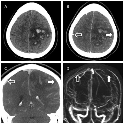 Ischemic Stroke Mri