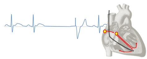 Single and dual chamber pacing modes | Deranged Physiology