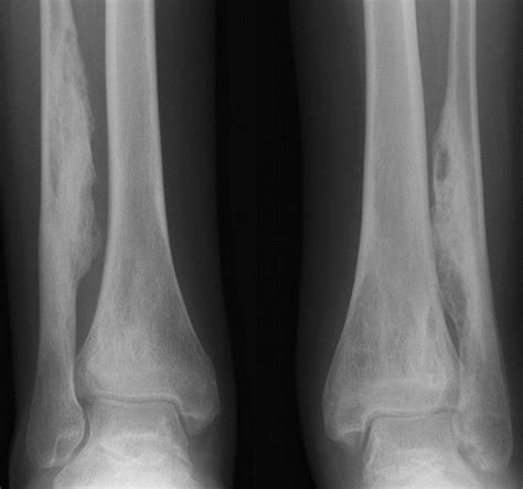 Osteomyelitis X Ray Features