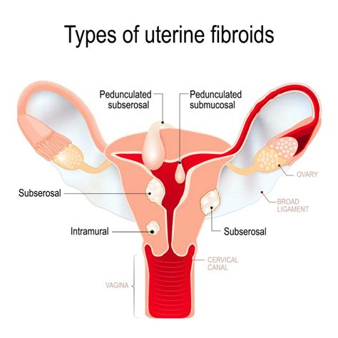 Uterine Fibroids: Symptoms | USA Fibroid Centers