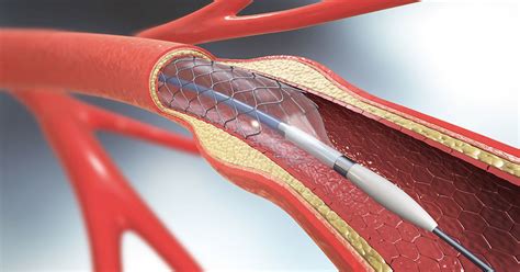 TCAR Reduces Stroke Risk During Carotid Artery Stenting | Froedtert & MCW