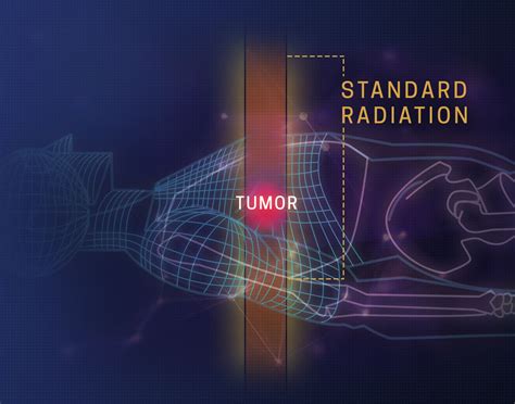 Pencil Beam Proton Therapy - All About Radiation