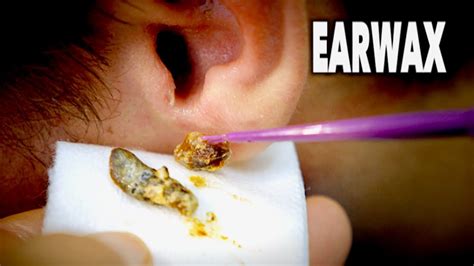 THE BEST EARWAX REMOVAL EVER! (and most gross) | Dr. Paul - YouTube