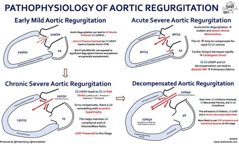 Aortic Regurgitation Pathophysiology