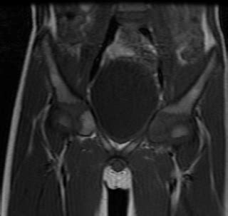 Osteoid Osteoma Acetabulum-MRI - Sumer's Radiology Blog