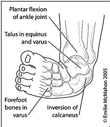 55 Talipes ideas | club foot, club foot baby, feet