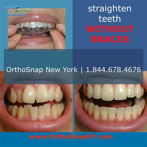 Pin by OrthoSnap New York on Clear Braces | Teeth straightening, Straight teeth without braces ...