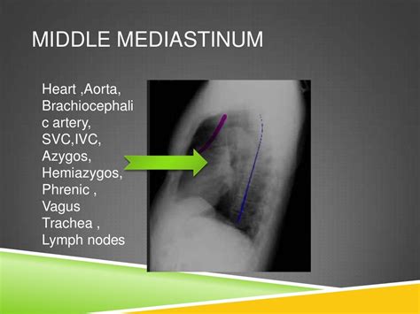 CT ANATOMY OF NORMAL MEDIASTINUM MADE EASY