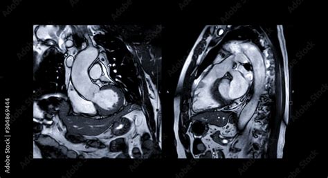 MRI heart or Cardiac MRI ( magnetic resonance imaging ) of heart compare RVOT and LVOT for ...