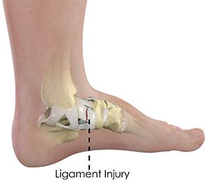 Ankle Ligament Injury Sydney, NSW | Ankle Reconstruction Surgery Randwick