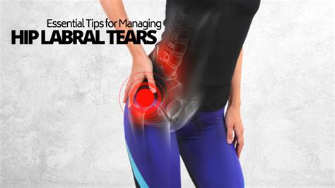 Essential Tips for Managing Your Hip Labral Tear - Functional Before Form