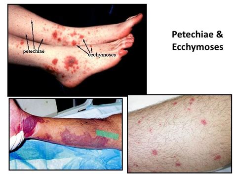 6 hemodynamic disorders