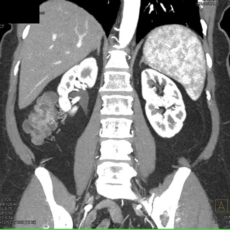 Incidental Cecal Carcinoma with Apple Core Like Lesion - Colon Case Studies - CTisus CT Scanning