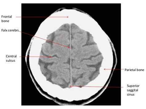 BASICS of CT Head