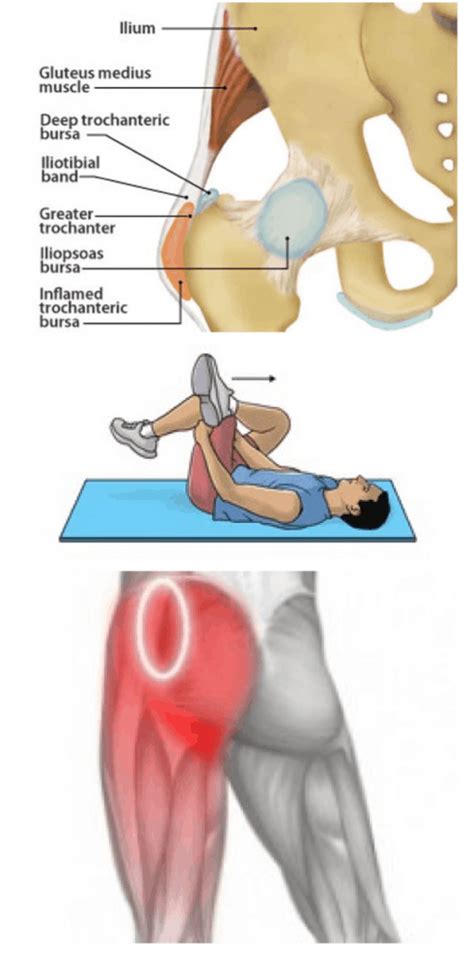 Greater Trochanteric Bursitis - Bút Chì Xanh