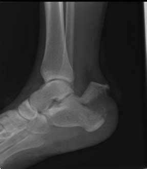 Calcaneus Fractures – OrthoSHO