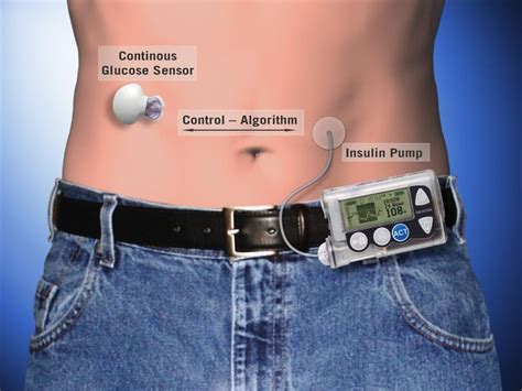 How An Artificial Pancreas Works | Here & Now