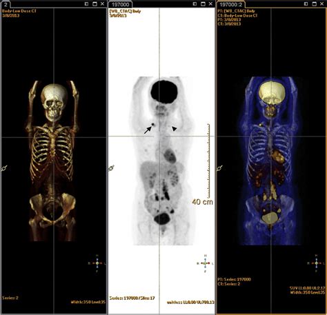 Pet Ct Scan Machine