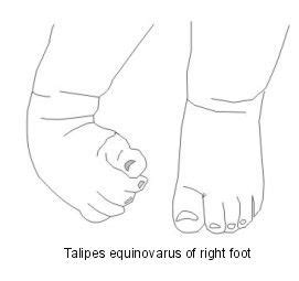 54 best images about Talipes on Pinterest | Physical therapy, Increase ...