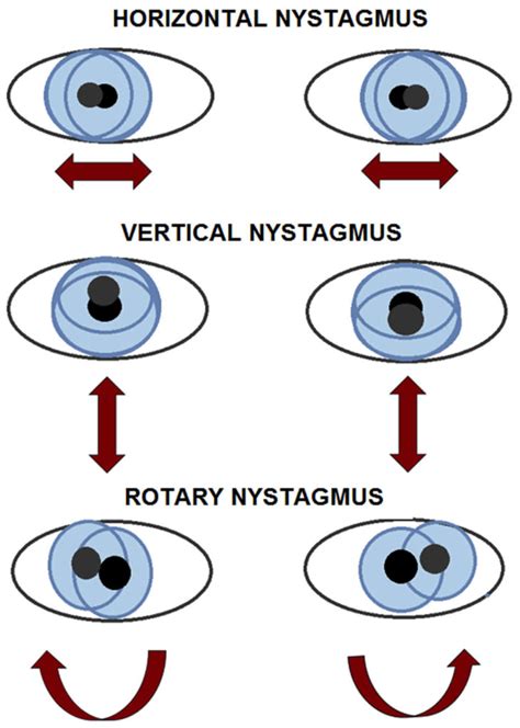Eye nystagmus causes, types, signs, symptoms, test & nystagmus treatment