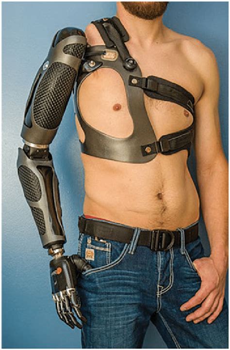 Myoelectric Prosthesis, Complex Hand, #Arm Dynamics. Photo permission... | Download Scientific ...