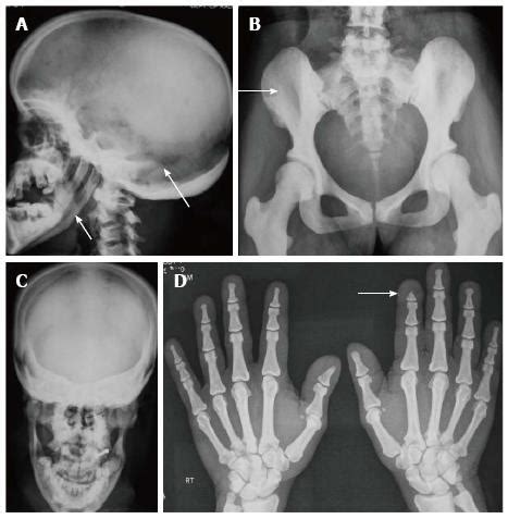 Craniodiaphyseal Dysplasia Skull