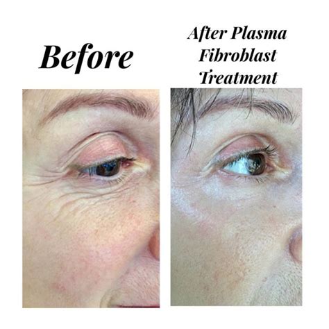 Plasma Fibroblast | Empire