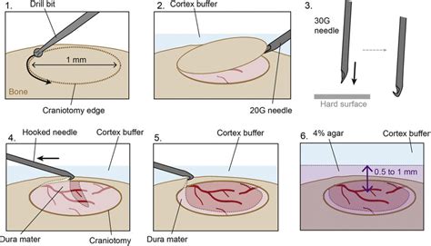 Craniotomy and durectomy Boxes 1-6 show key steps of the procedure.... | Download Scientific Diagram