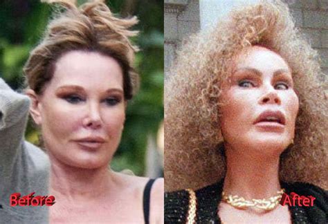 Catwoman Plastic Surgery: From Bad to Worse - Plastic Surgery Mistakes