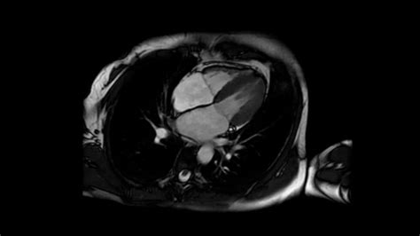 Resonancia cardíaca: ¿qué es? - Origen, Diagnóstico y traumatología