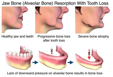 Jaw bone loss due to tooth loss and dentures | Jaw bone, Bone loss ...